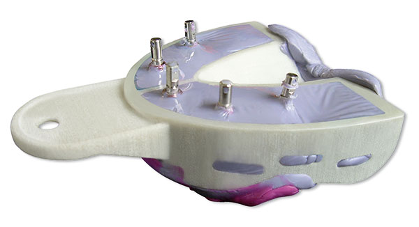 Miratray Implant Advanced Impression Tray